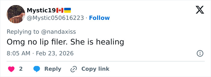 “She Dissolved That Lip?”: Fans Spot Major Detail In Kylie Jenner’s Appearance At The 2026 BAFTAs “She Dissolved That Lip?”: Fans Spot Major Detail In Kylie Jenner’s Appearance At The 2026 BAFTAs