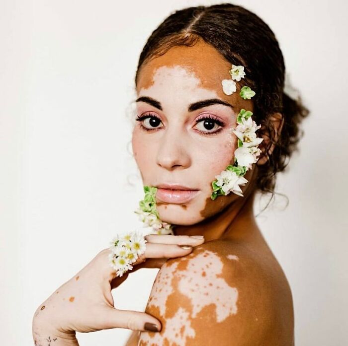 35 Stunning Portraits That Celebrate The Unique Beauty Of People With Vitiligo 35 Stunning Portraits That Celebrate The Unique Beauty Of People With Vitiligo