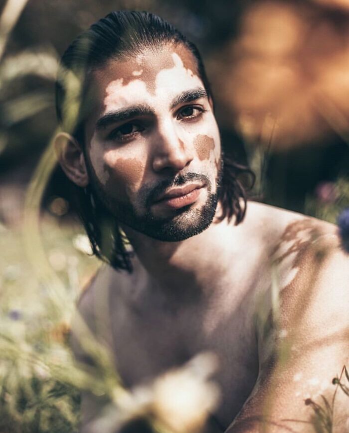 35 Stunning Portraits That Celebrate The Unique Beauty Of People With Vitiligo 35 Stunning Portraits That Celebrate The Unique Beauty Of People With Vitiligo
