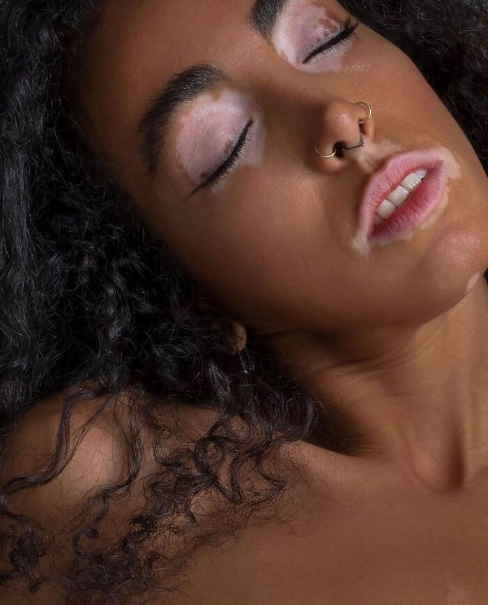 35 Stunning Portraits That Celebrate The Unique Beauty Of People With Vitiligo 35 Stunning Portraits That Celebrate The Unique Beauty Of People With Vitiligo