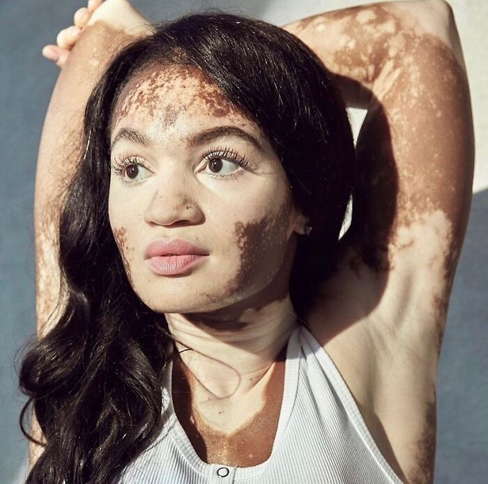 35 Stunning Portraits That Celebrate The Unique Beauty Of People With Vitiligo 35 Stunning Portraits That Celebrate The Unique Beauty Of People With Vitiligo
