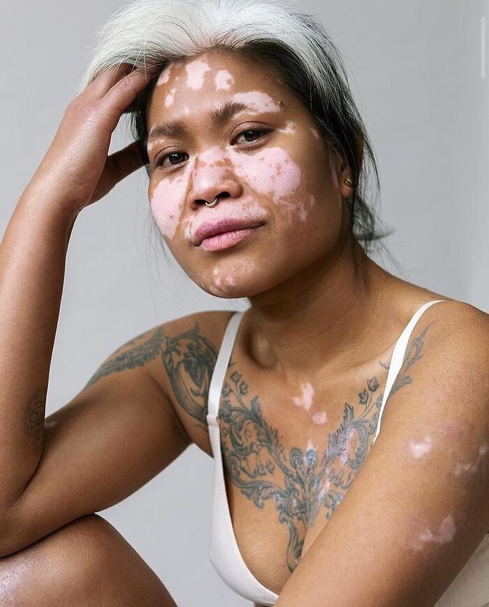 35 Stunning Portraits That Celebrate The Unique Beauty Of People With Vitiligo 35 Stunning Portraits That Celebrate The Unique Beauty Of People With Vitiligo