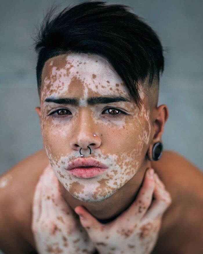 35 Stunning Portraits That Celebrate The Unique Beauty Of People With Vitiligo 35 Stunning Portraits That Celebrate The Unique Beauty Of People With Vitiligo