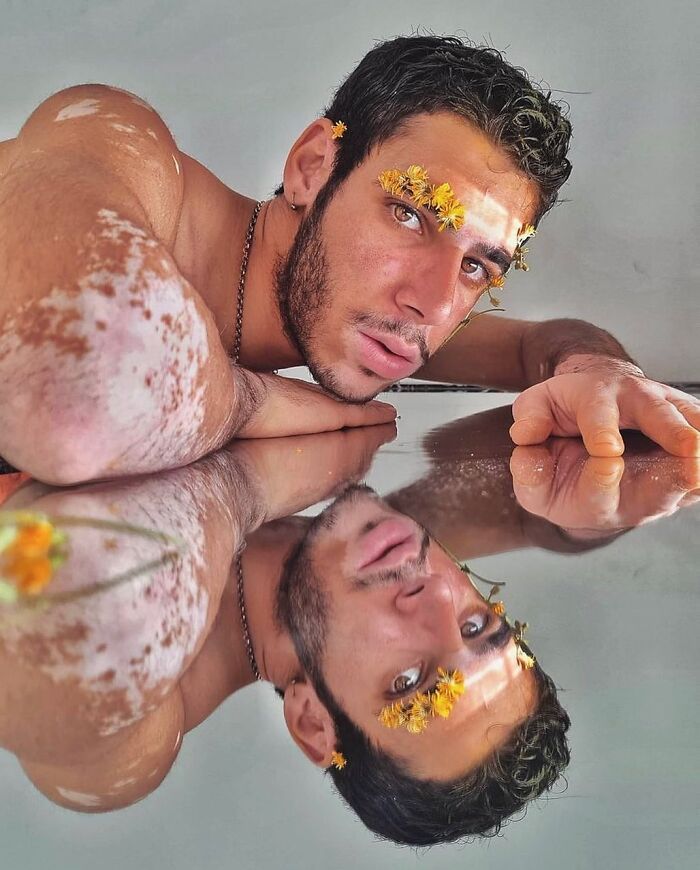 35 Stunning Portraits That Celebrate The Unique Beauty Of People With Vitiligo 35 Stunning Portraits That Celebrate The Unique Beauty Of People With Vitiligo