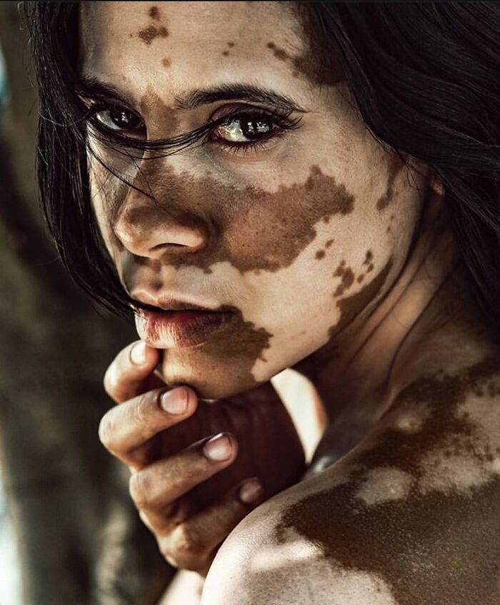 35 Stunning Portraits That Celebrate The Unique Beauty Of People With Vitiligo 35 Stunning Portraits That Celebrate The Unique Beauty Of People With Vitiligo