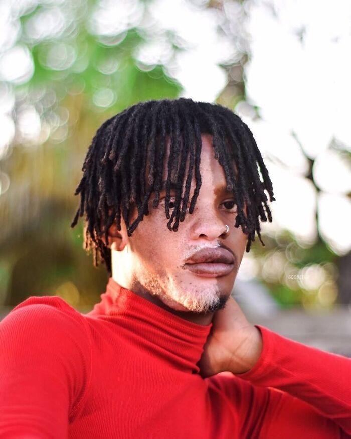 35 Stunning Portraits That Celebrate The Unique Beauty Of People With Vitiligo 35 Stunning Portraits That Celebrate The Unique Beauty Of People With Vitiligo