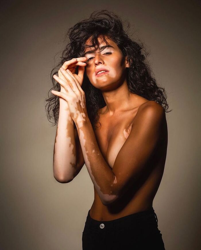 35 Stunning Portraits That Celebrate The Unique Beauty Of People With Vitiligo 35 Stunning Portraits That Celebrate The Unique Beauty Of People With Vitiligo