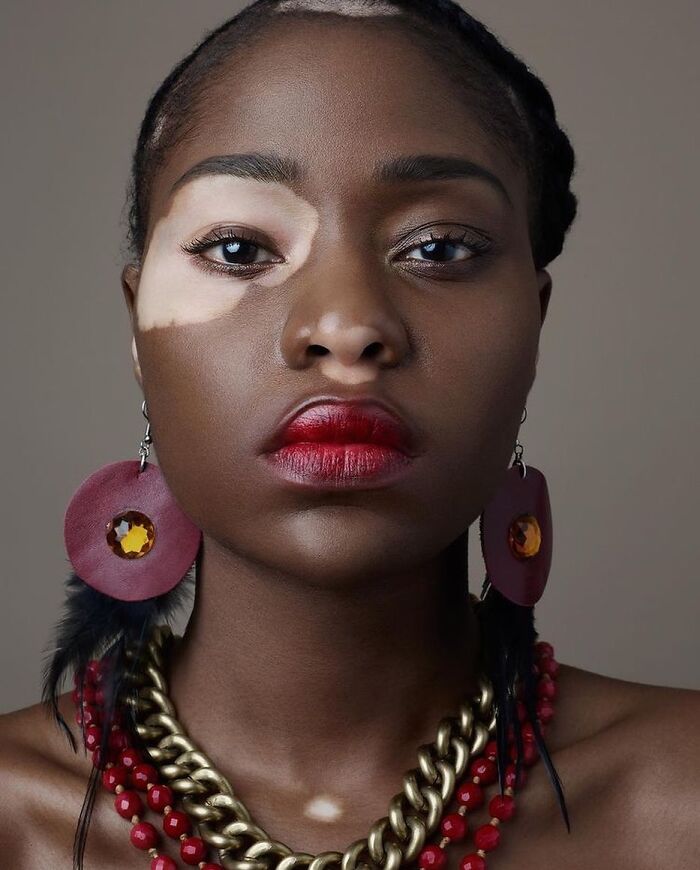 35 Stunning Portraits That Celebrate The Unique Beauty Of People With Vitiligo 35 Stunning Portraits That Celebrate The Unique Beauty Of People With Vitiligo