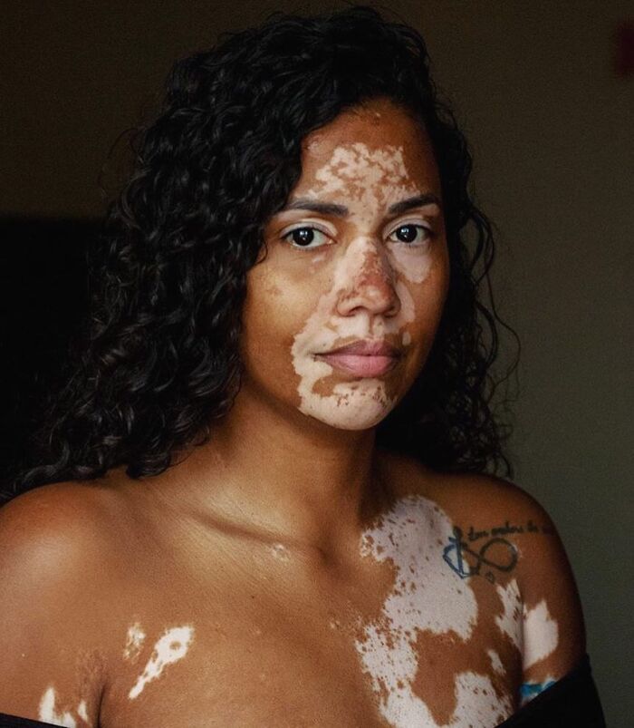 35 Stunning Portraits That Celebrate The Unique Beauty Of People With Vitiligo 35 Stunning Portraits That Celebrate The Unique Beauty Of People With Vitiligo