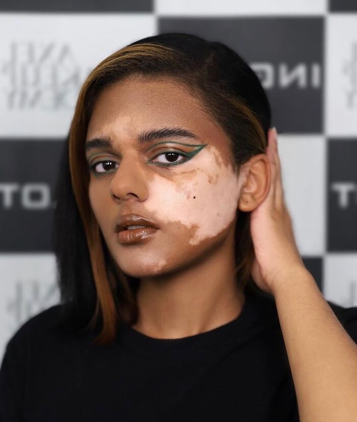 35 Stunning Portraits That Celebrate The Unique Beauty Of People With Vitiligo 35 Stunning Portraits That Celebrate The Unique Beauty Of People With Vitiligo