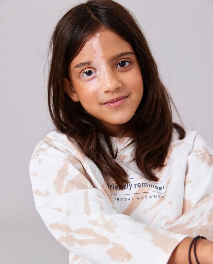 35 Stunning Portraits That Celebrate The Unique Beauty Of People With Vitiligo 35 Stunning Portraits That Celebrate The Unique Beauty Of People With Vitiligo