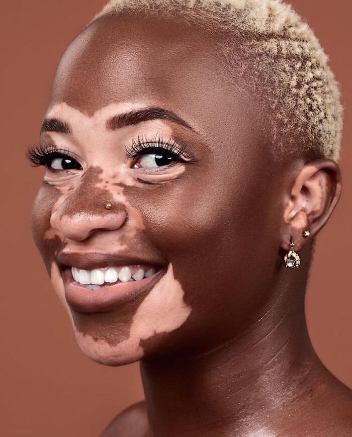 35 Stunning Portraits That Celebrate The Unique Beauty Of People With Vitiligo 35 Stunning Portraits That Celebrate The Unique Beauty Of People With Vitiligo