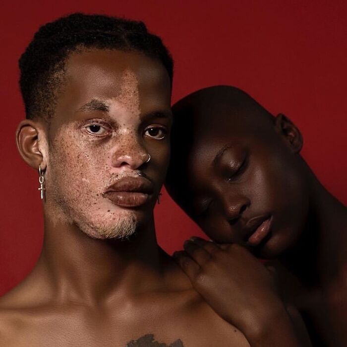 35 Stunning Portraits That Celebrate The Unique Beauty Of People With Vitiligo 35 Stunning Portraits That Celebrate The Unique Beauty Of People With Vitiligo
