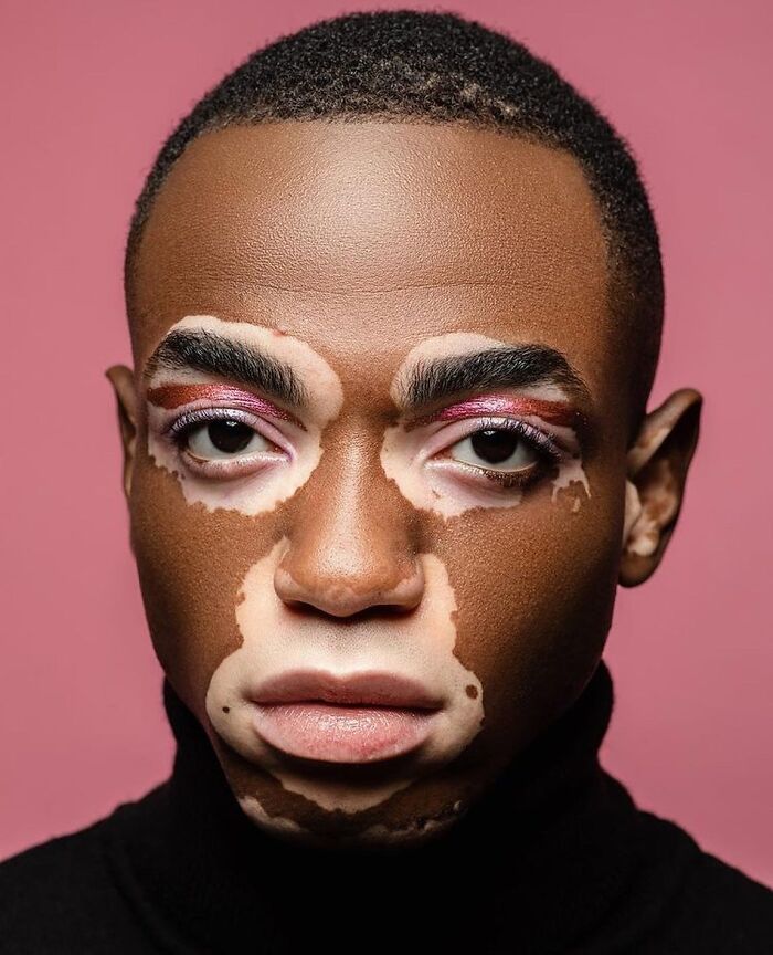 35 Stunning Portraits That Celebrate The Unique Beauty Of People With Vitiligo 35 Stunning Portraits That Celebrate The Unique Beauty Of People With Vitiligo