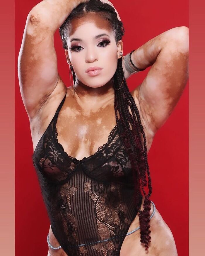 35 Stunning Portraits That Celebrate The Unique Beauty Of People With Vitiligo 35 Stunning Portraits That Celebrate The Unique Beauty Of People With Vitiligo