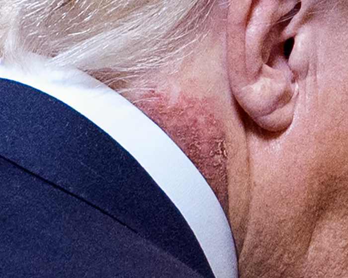 Doctors Weigh In On Trump’s Neck Rash, Suggesting Likely Cause Amid White House’s ‘Preventative Treatment’ Claim Doctors Weigh In On Trump’s Neck Rash, Suggesting Likely Cause Amid White House’s ‘Preventative Treatment’ Claim