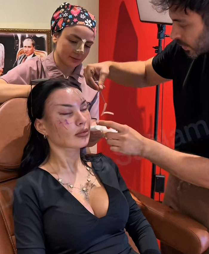 &ldquo;Someone PAID For This”: People Go Wild Mocking Woman&rsquo;s Before-And-After Cosmetic Procedure