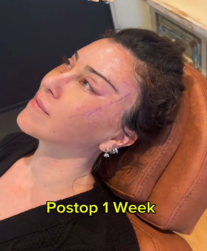 &ldquo;Someone PAID For This”: People Go Wild Mocking Woman&rsquo;s Before-And-After Cosmetic Procedure
