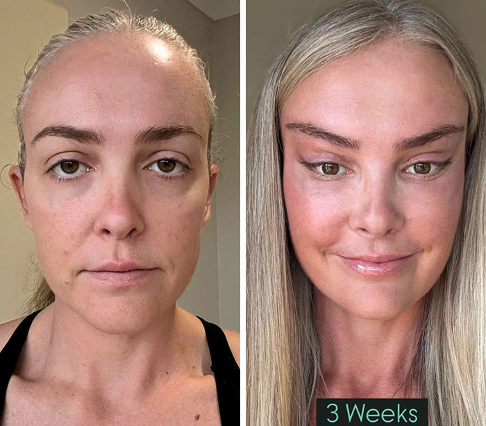 &ldquo;Someone PAID For This”: People Go Wild Mocking Woman&rsquo;s Before-And-After Cosmetic Procedure