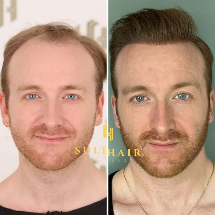 Surgeons Show What A Hair Transplant Can Do With 81 Before And After Pics Surgeons Show What A Hair Transplant Can Do With 81 Before And After Pics