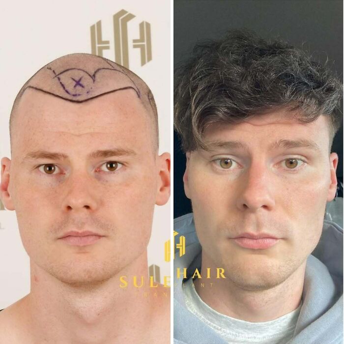 Surgeons Show What A Hair Transplant Can Do With 81 Before And After Pics Surgeons Show What A Hair Transplant Can Do With 81 Before And After Pics