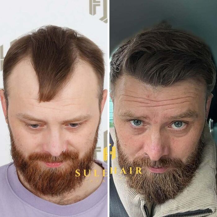 Surgeons Show What A Hair Transplant Can Do With 81 Before And After Pics Surgeons Show What A Hair Transplant Can Do With 81 Before And After Pics