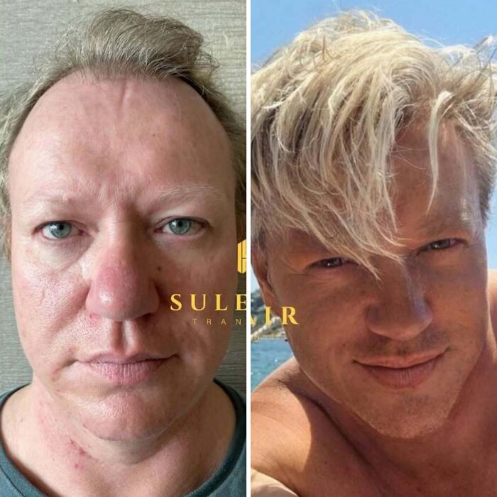 Surgeons Show What A Hair Transplant Can Do With 81 Before And After Pics Surgeons Show What A Hair Transplant Can Do With 81 Before And After Pics