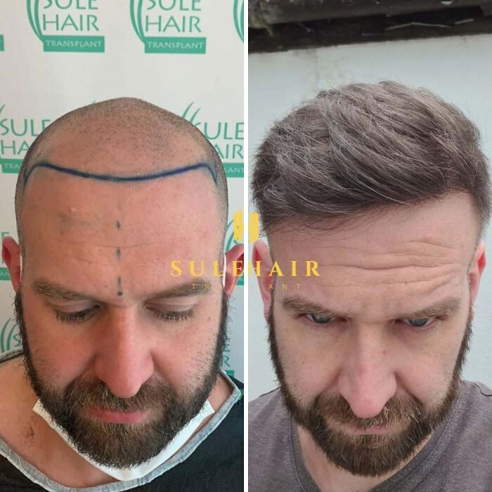 Surgeons Show What A Hair Transplant Can Do With 81 Before And After Pics Surgeons Show What A Hair Transplant Can Do With 81 Before And After Pics
