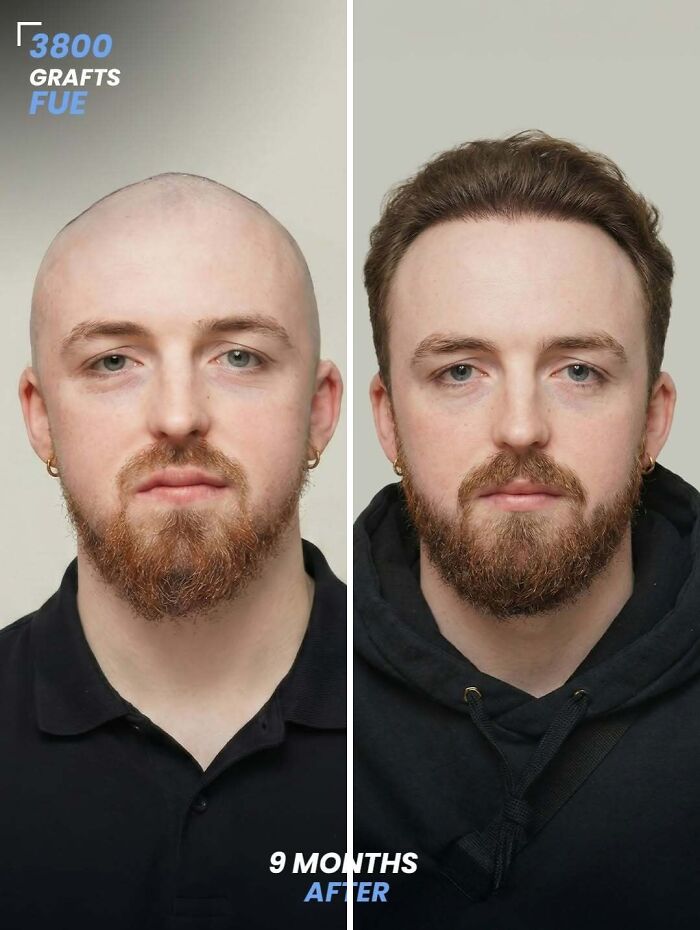 Surgeons Show What A Hair Transplant Can Do With 81 Before And After Pics Surgeons Show What A Hair Transplant Can Do With 81 Before And After Pics