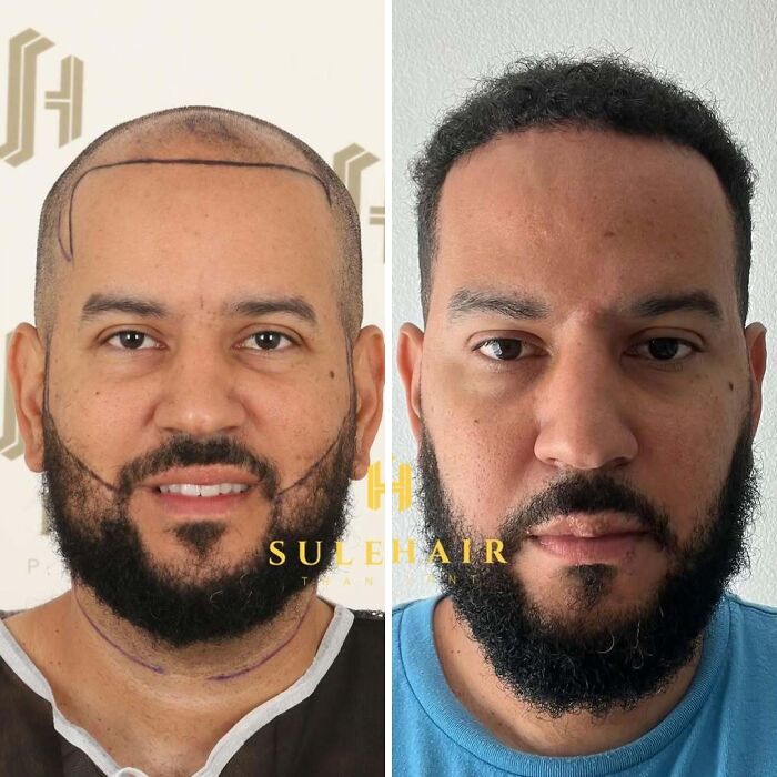 Surgeons Show What A Hair Transplant Can Do With 81 Before And After Pics Surgeons Show What A Hair Transplant Can Do With 81 Before And After Pics
