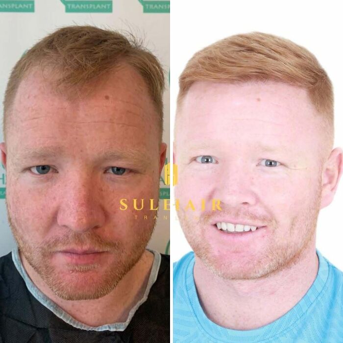Surgeons Show What A Hair Transplant Can Do With 81 Before And After Pics Surgeons Show What A Hair Transplant Can Do With 81 Before And After Pics