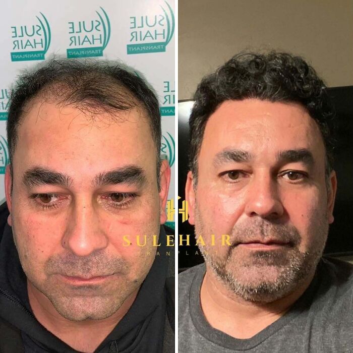 Surgeons Show What A Hair Transplant Can Do With 81 Before And After Pics Surgeons Show What A Hair Transplant Can Do With 81 Before And After Pics