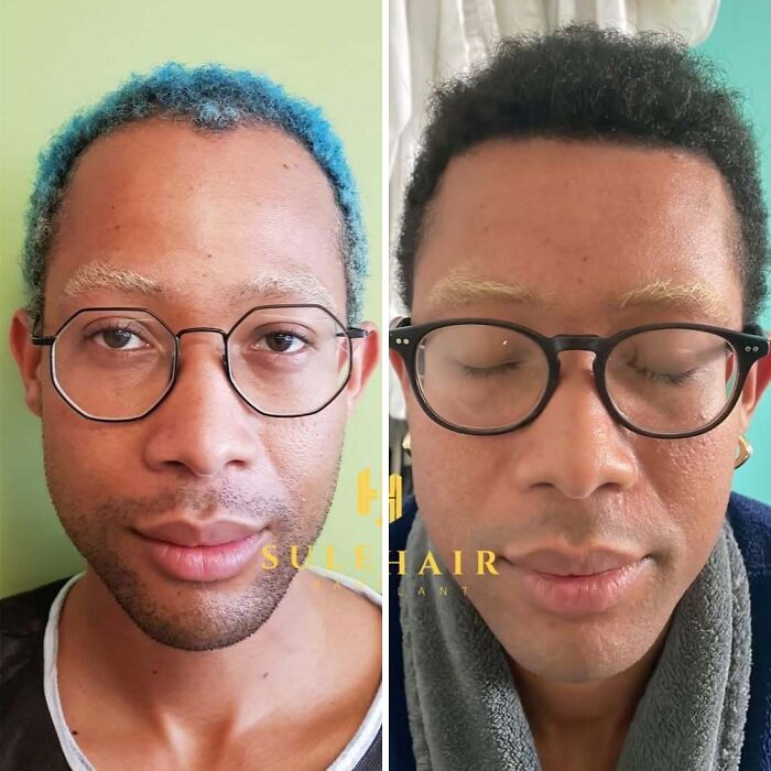 Surgeons Show What A Hair Transplant Can Do With 81 Before And After Pics Surgeons Show What A Hair Transplant Can Do With 81 Before And After Pics