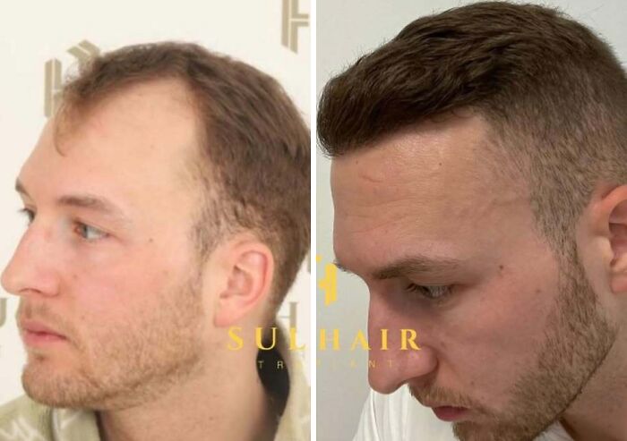 Surgeons Show What A Hair Transplant Can Do With 81 Before And After Pics Surgeons Show What A Hair Transplant Can Do With 81 Before And After Pics