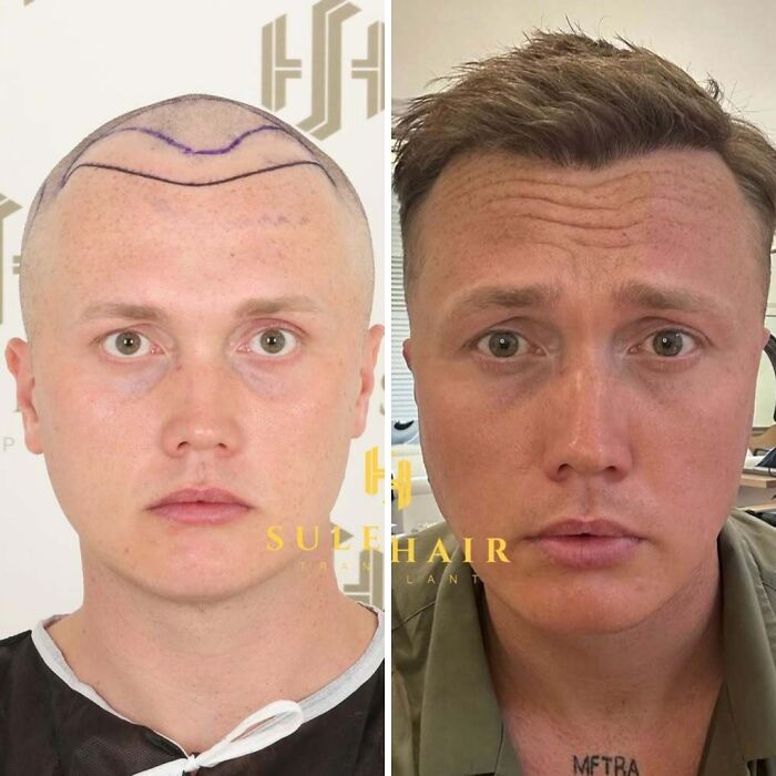 Surgeons Show What A Hair Transplant Can Do With 81 Before And After Pics Surgeons Show What A Hair Transplant Can Do With 81 Before And After Pics