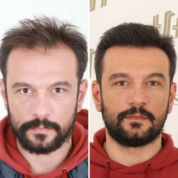 Surgeons Show What A Hair Transplant Can Do With 81 Before And After Pics Surgeons Show What A Hair Transplant Can Do With 81 Before And After Pics