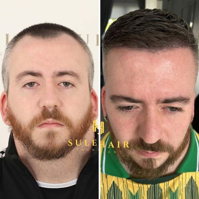 Surgeons Show What A Hair Transplant Can Do With 81 Before And After Pics Surgeons Show What A Hair Transplant Can Do With 81 Before And After Pics