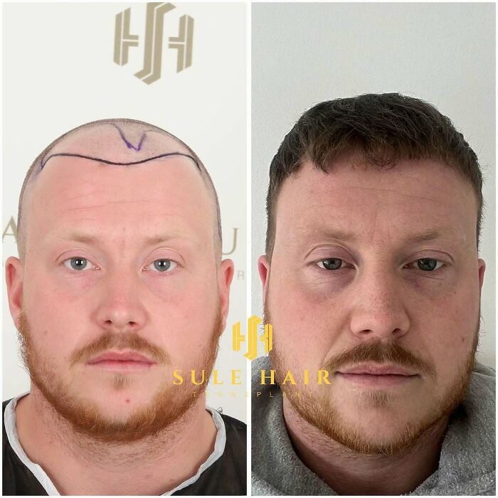 Surgeons Show What A Hair Transplant Can Do With 81 Before And After Pics Surgeons Show What A Hair Transplant Can Do With 81 Before And After Pics