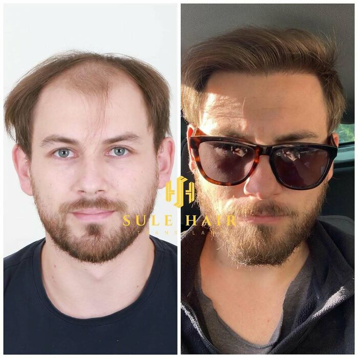 Surgeons Show What A Hair Transplant Can Do With 81 Before And After Pics Surgeons Show What A Hair Transplant Can Do With 81 Before And After Pics