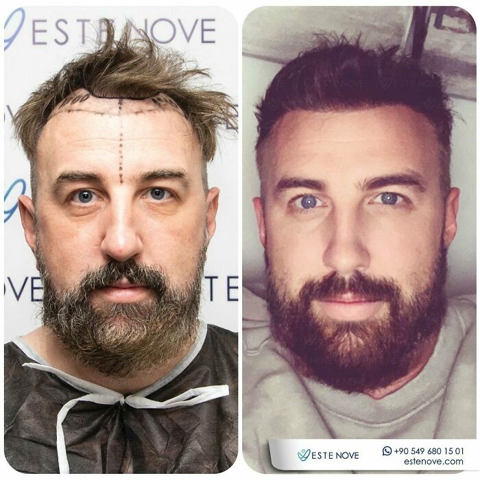 Surgeons Show What A Hair Transplant Can Do With 81 Before And After Pics Surgeons Show What A Hair Transplant Can Do With 81 Before And After Pics