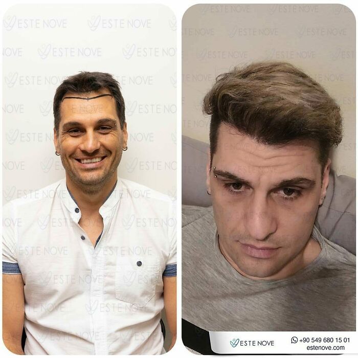 Surgeons Show What A Hair Transplant Can Do With 81 Before And After Pics Surgeons Show What A Hair Transplant Can Do With 81 Before And After Pics