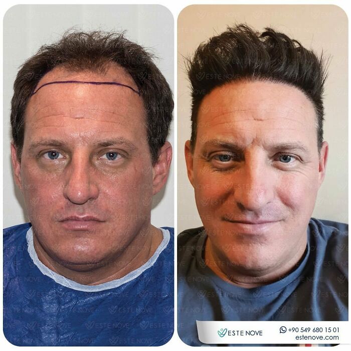 Surgeons Show What A Hair Transplant Can Do With 81 Before And After Pics Surgeons Show What A Hair Transplant Can Do With 81 Before And After Pics