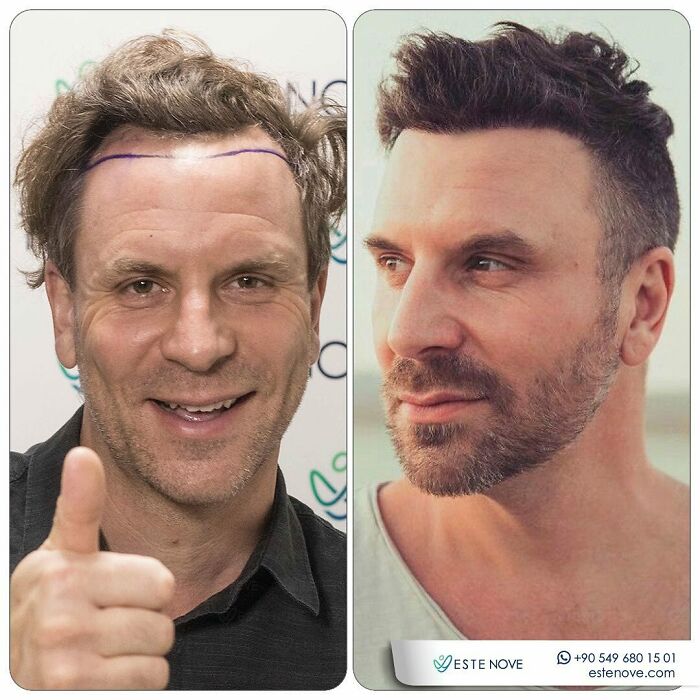 Surgeons Show What A Hair Transplant Can Do With 81 Before And After Pics Surgeons Show What A Hair Transplant Can Do With 81 Before And After Pics