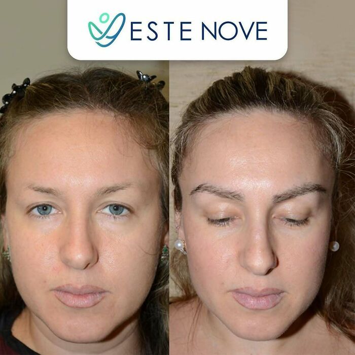 Surgeons Show What A Hair Transplant Can Do With 81 Before And After Pics Surgeons Show What A Hair Transplant Can Do With 81 Before And After Pics