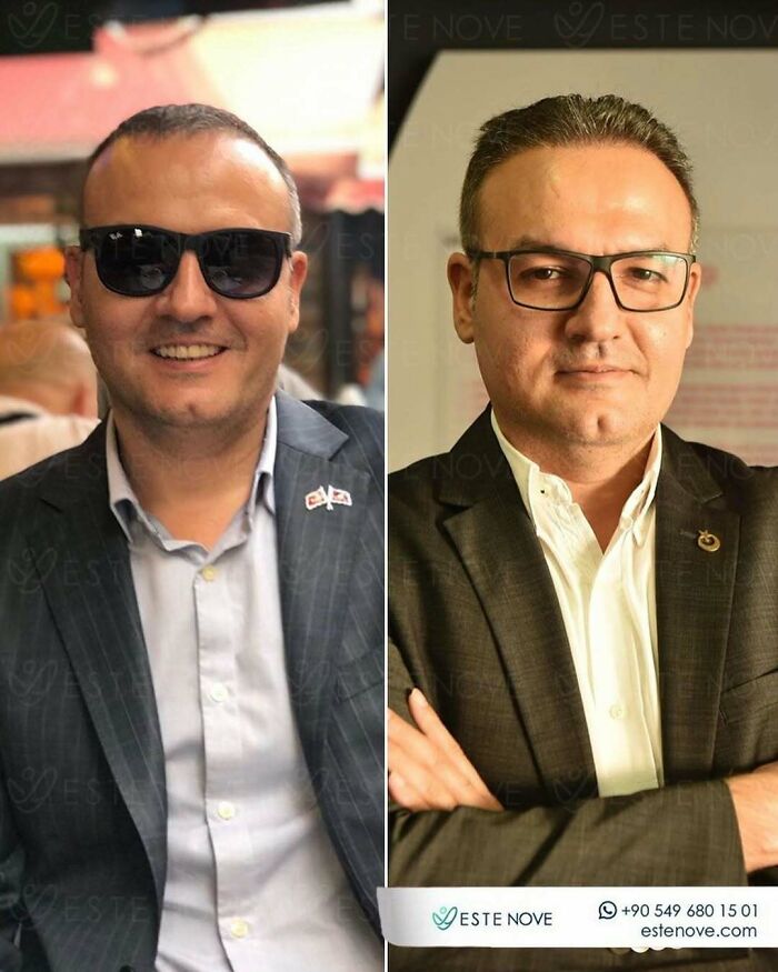 Surgeons Show What A Hair Transplant Can Do With 81 Before And After Pics Surgeons Show What A Hair Transplant Can Do With 81 Before And After Pics