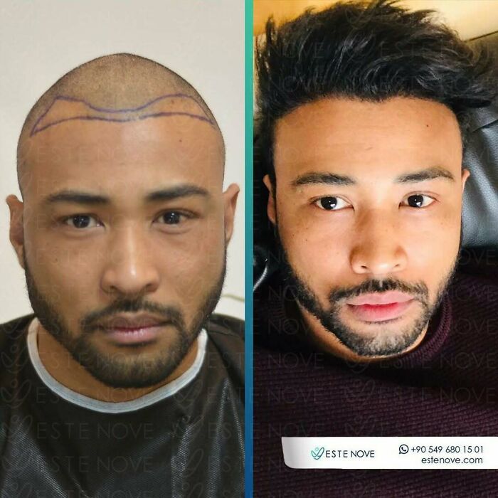 Surgeons Show What A Hair Transplant Can Do With 81 Before And After Pics Surgeons Show What A Hair Transplant Can Do With 81 Before And After Pics