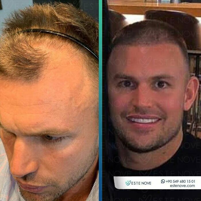 Surgeons Show What A Hair Transplant Can Do With 81 Before And After Pics Surgeons Show What A Hair Transplant Can Do With 81 Before And After Pics