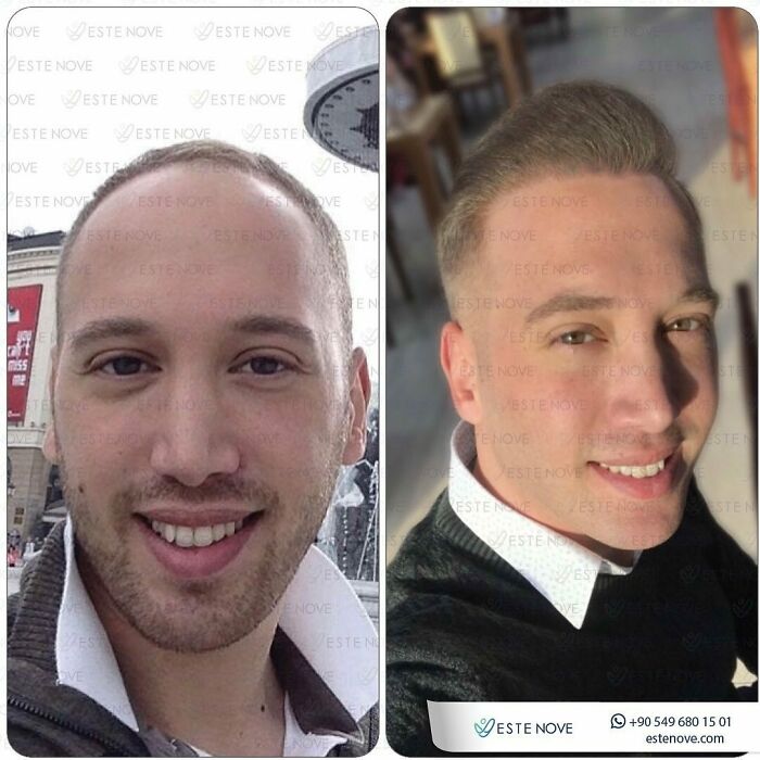 Surgeons Show What A Hair Transplant Can Do With 81 Before And After Pics Surgeons Show What A Hair Transplant Can Do With 81 Before And After Pics