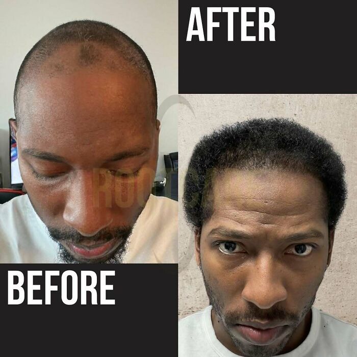 Surgeons Show What A Hair Transplant Can Do With 81 Before And After Pics Surgeons Show What A Hair Transplant Can Do With 81 Before And After Pics