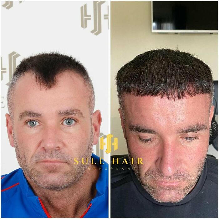 Surgeons Show What A Hair Transplant Can Do With 81 Before And After Pics Surgeons Show What A Hair Transplant Can Do With 81 Before And After Pics